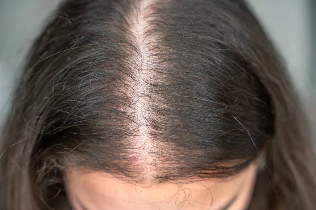 Thinning